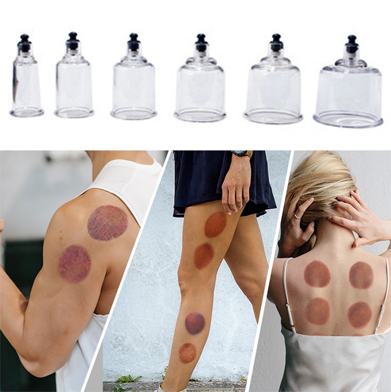 Set bekam terapi 17 kaleng, ca - Cupping Therapy Set ulasan dan harga