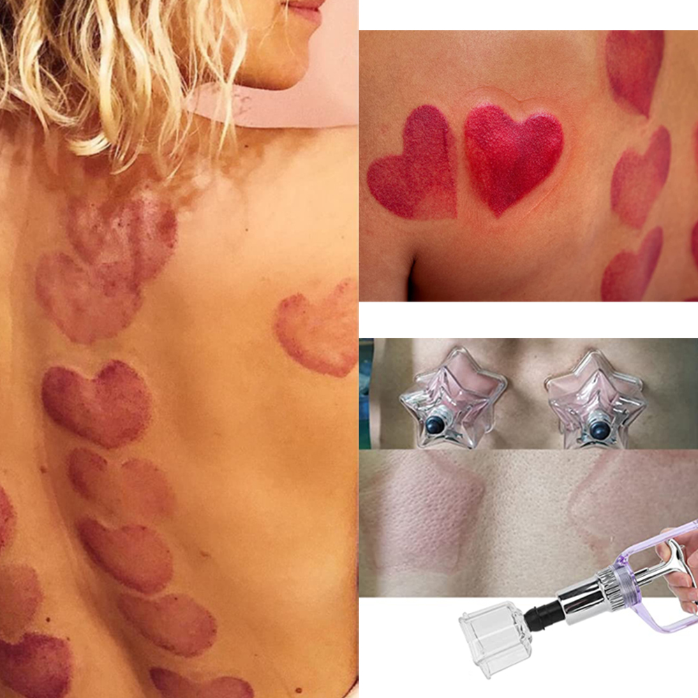 Gaya baru 4 buah Set terapi be - Cupping Therapy Set ulasan dan harga